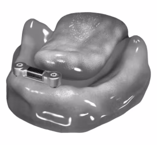 1_belka-doldera-w-zuchwie-protezy-na-implantach