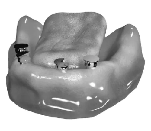 4-x-Locator-implanty-w-zuchwie