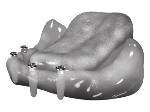 proteza-na-implantach-w-zuchwie-4-x-Locator-1