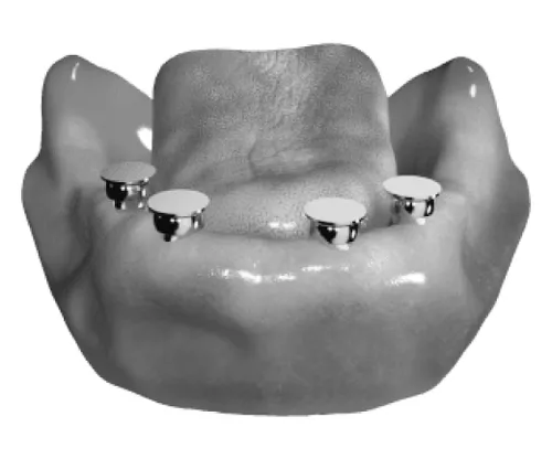 czapeczki-Locator-implanty-w-zuchwie