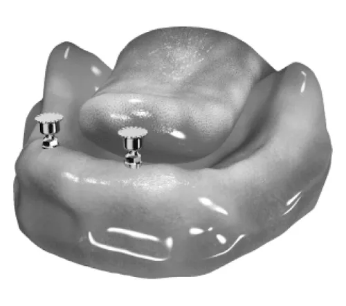 zatrzaski-na-implantach-w-zuchwie-1