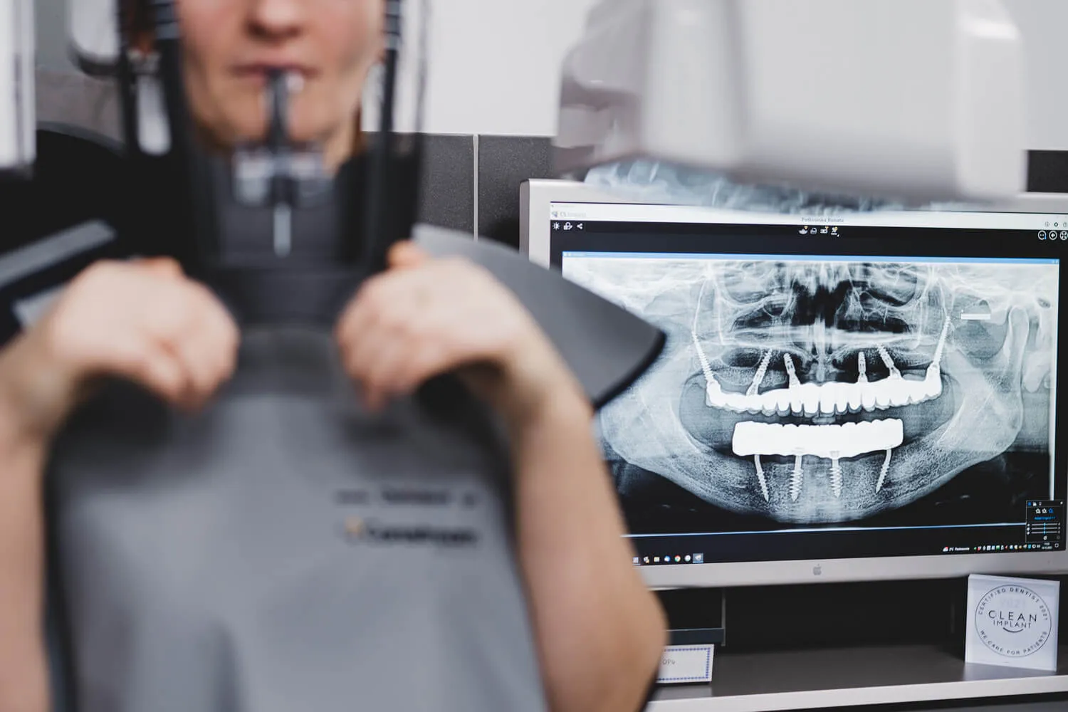 Full-jaw-tooth-implants-price-Szczecin