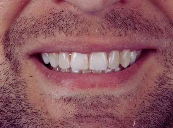 metamorphosis-przemyslaw-after