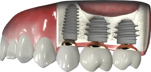 bone-regeneration-implant-integration