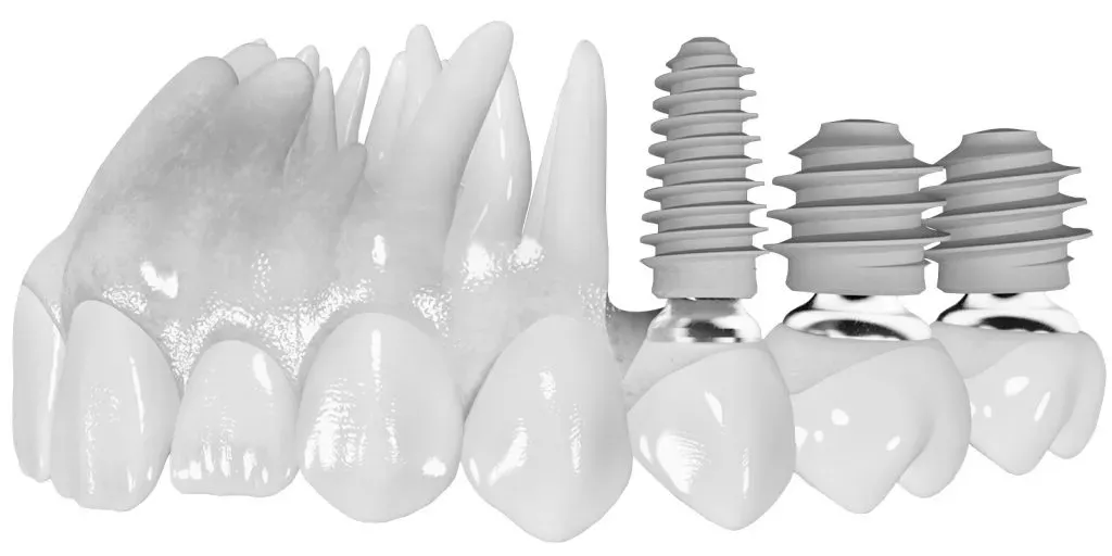 comparison-implant-short-and-long