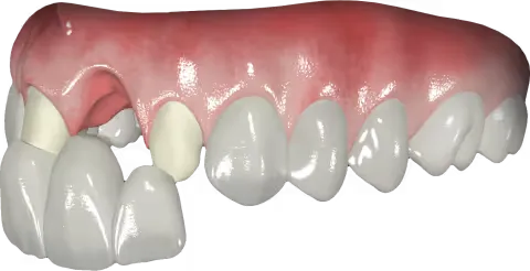 bridge-on-teeth-szczecin