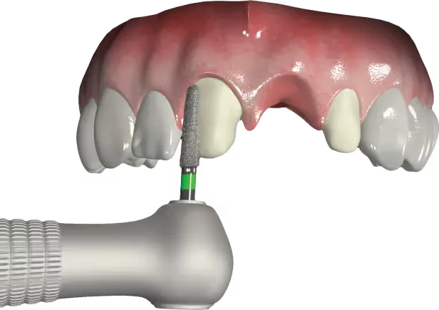 dental-bridges-stomatologia-na-podzamczu