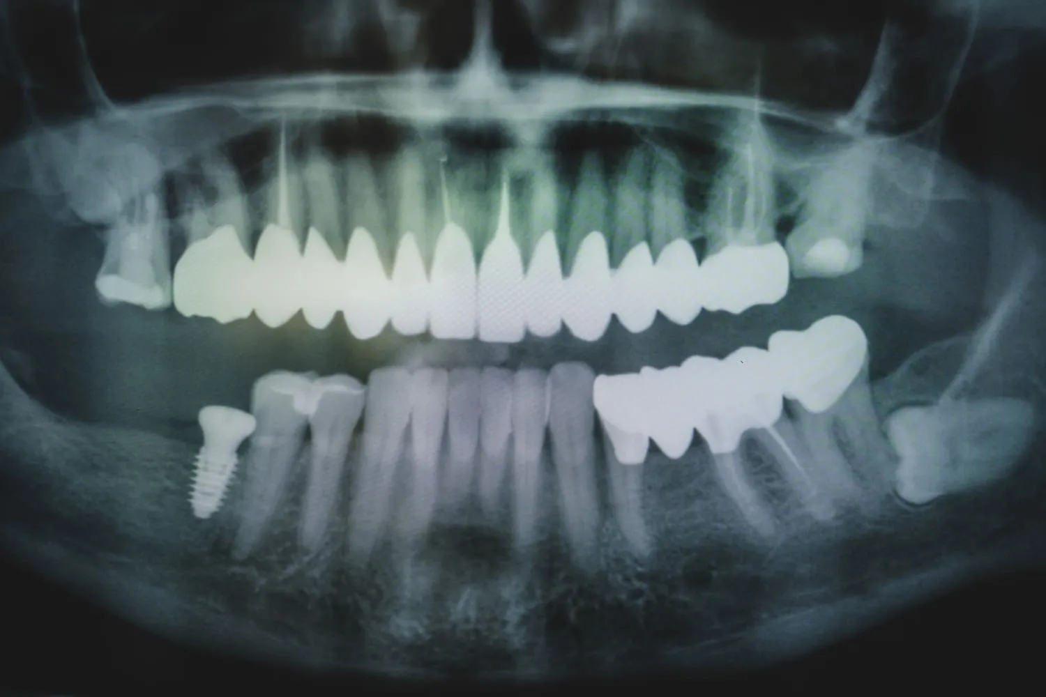 dental-crowns-szczecin-stomatologia-na-podzamczu