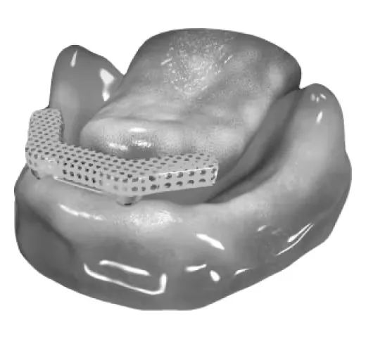 dolder-bar-on-two-implants-in-the-mandible