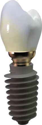 Tooth-implant-with-crown-Szczecin-AnyRidge-Megagen