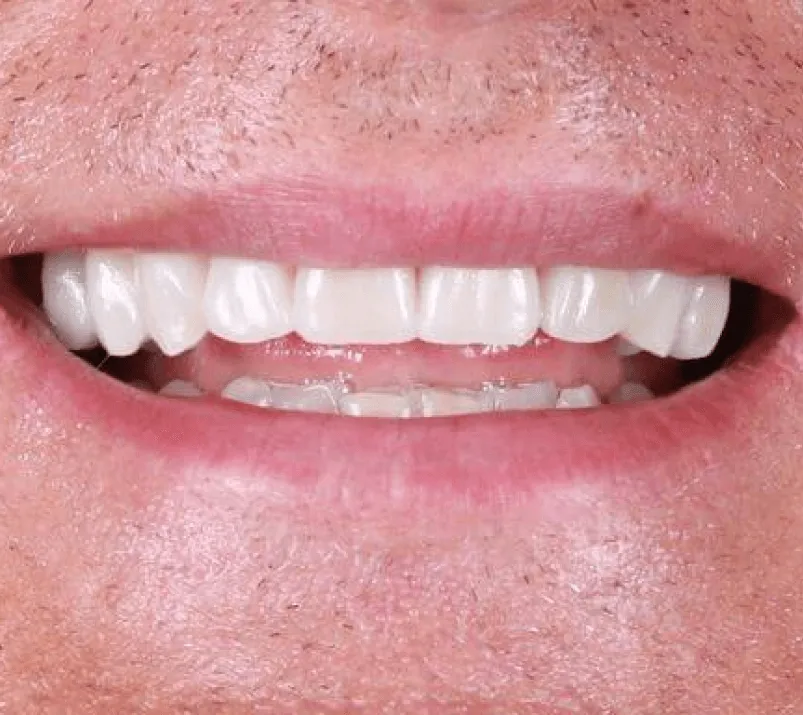 metamorphosis-smile-design-szczecin-after-1