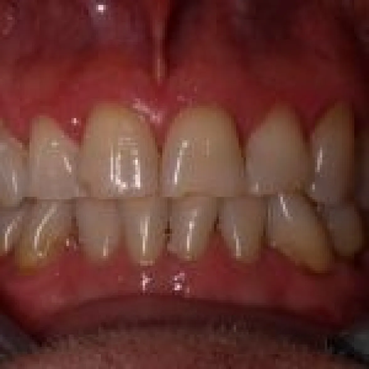 metamorphosis-smile-design-szczecin-before