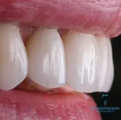 natural-porcelain-veneers-szczecin-snp