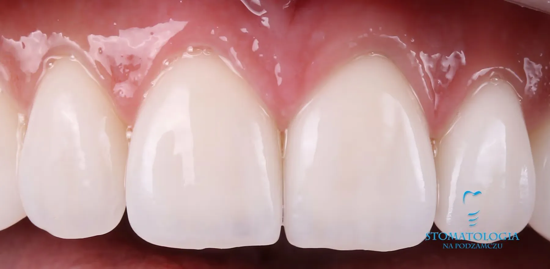 porcelain-veneers-on-front-teeth