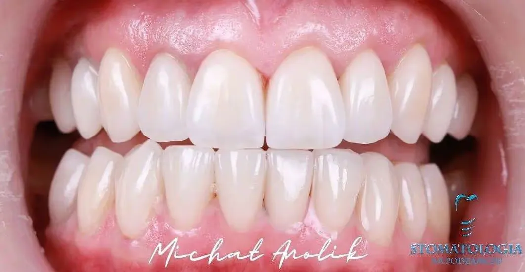 porcelain-veneers-top-and-bottom