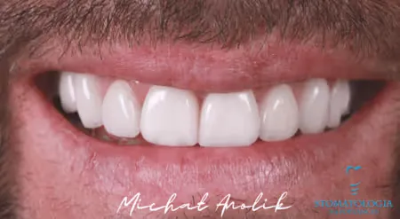 porcelain-veneers-snp-3