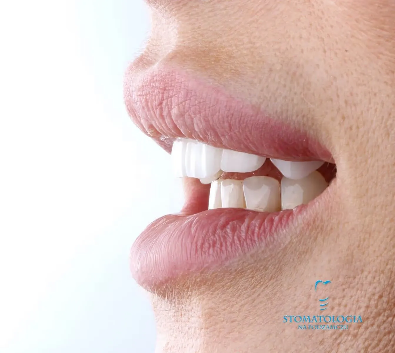 porcelain-veneers-snp-02