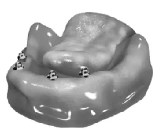 prosthesis-on-implants-with-a-beam