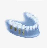 snp-treatment-implants-options