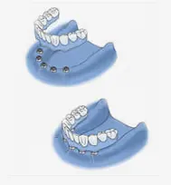 treatment-options-all-on-4-snp