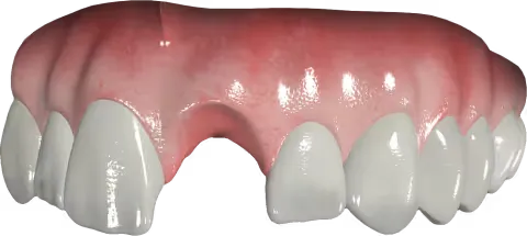 tooth-replacements-bridges-szczecin