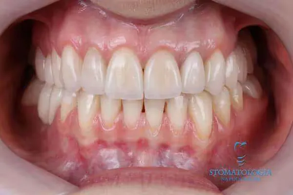 veneers-in-natural-color
