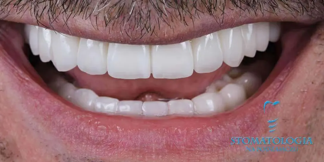 veneers-on-a-man