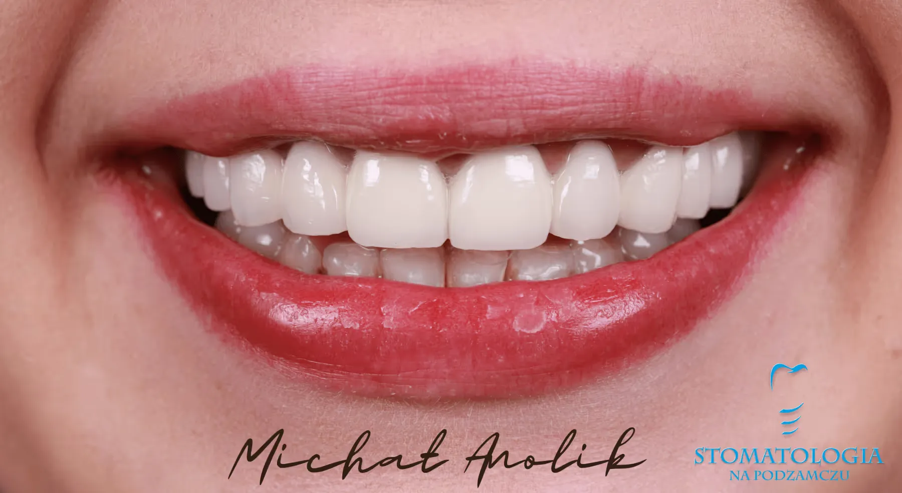 veneers-on-front-teeth-szczecin