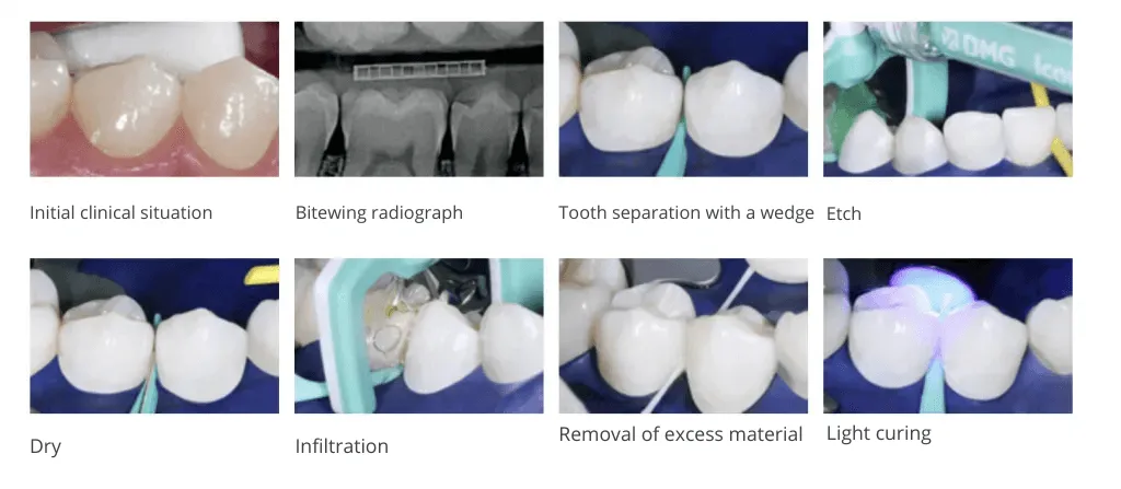 ICON-Szczecin-treatment-of-white-spots-on-teeth