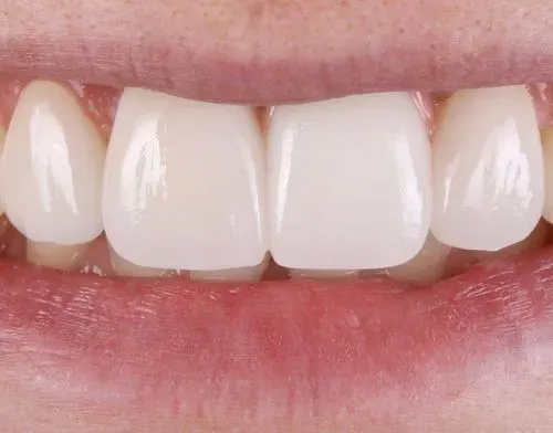 veneers-front-teeh-smile