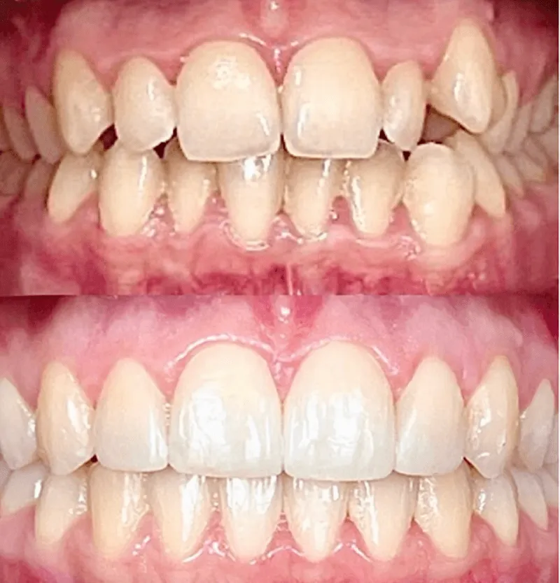 invisalign-przed-po-przypadek-2