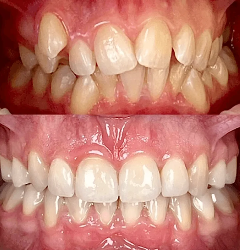 invisalign-przed-po-przypadek-1
