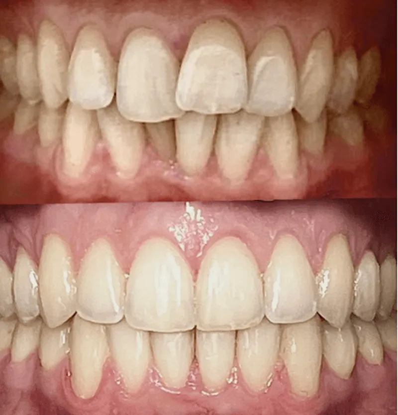 invisalign-przed-po-przypadek-4