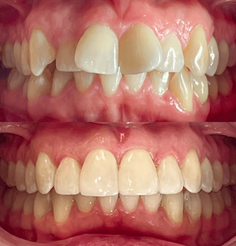 invisalign-przed-po-przypadek-6
