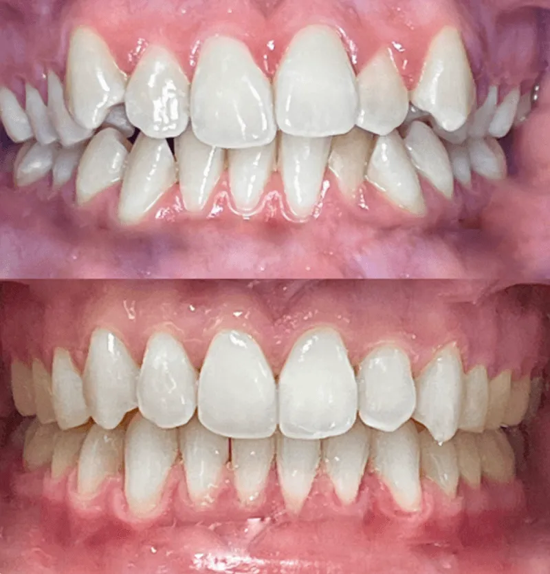 invisalign-przed-po-przypadek-5