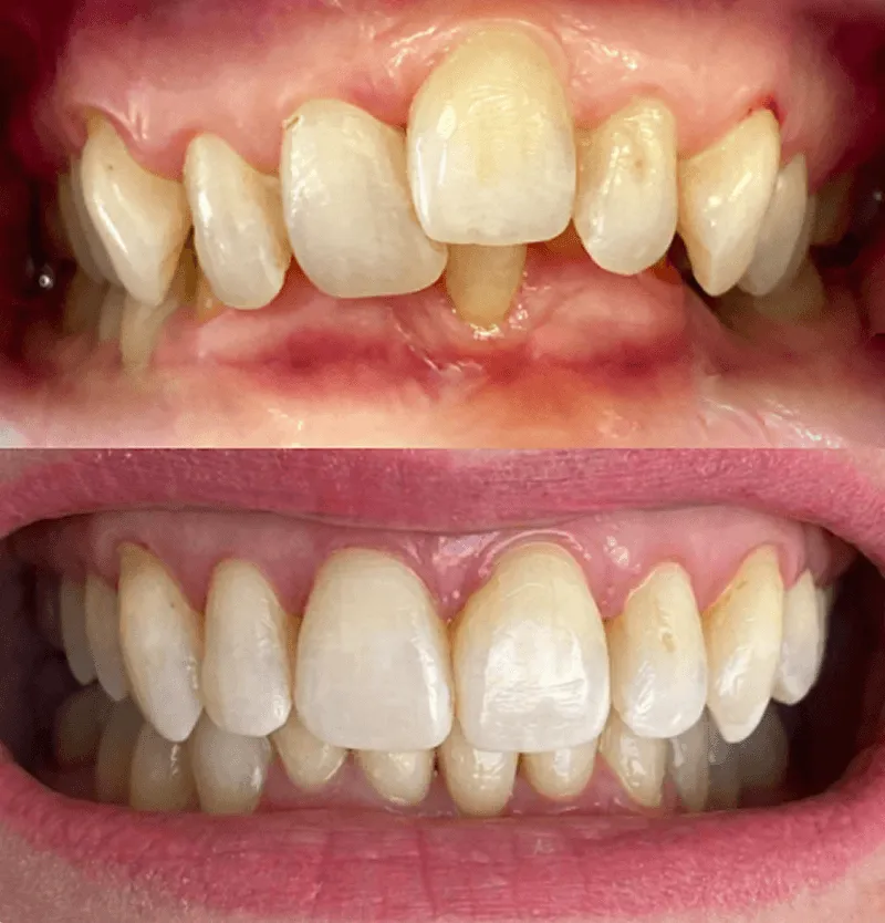 invisalign-przed-po-przypadek-3