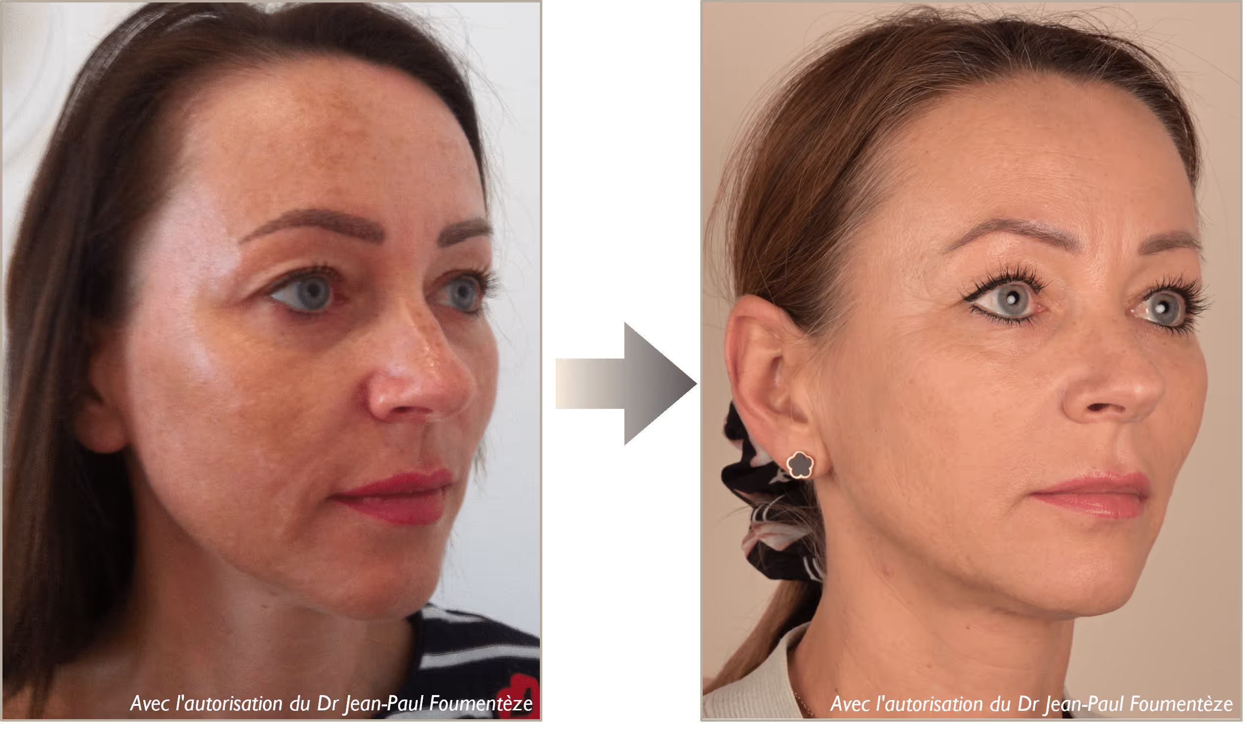 2 images d'une même femme, brune aux yeux bleus, avant et après l'opération des fils tenseurs