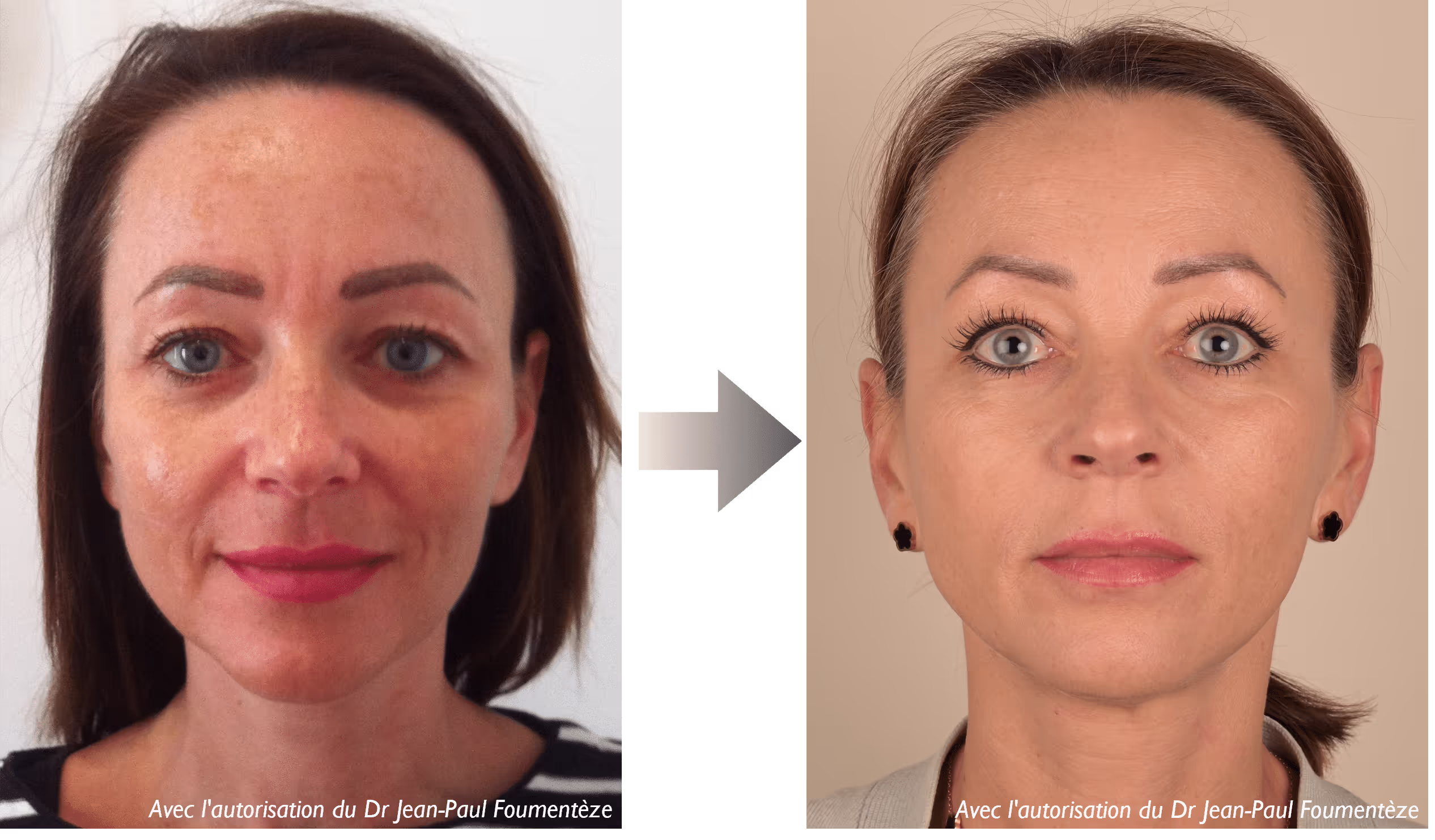 2 images d'une même femme, brune aux yeux bleus, avant et après l'opération des fils tenseurs
