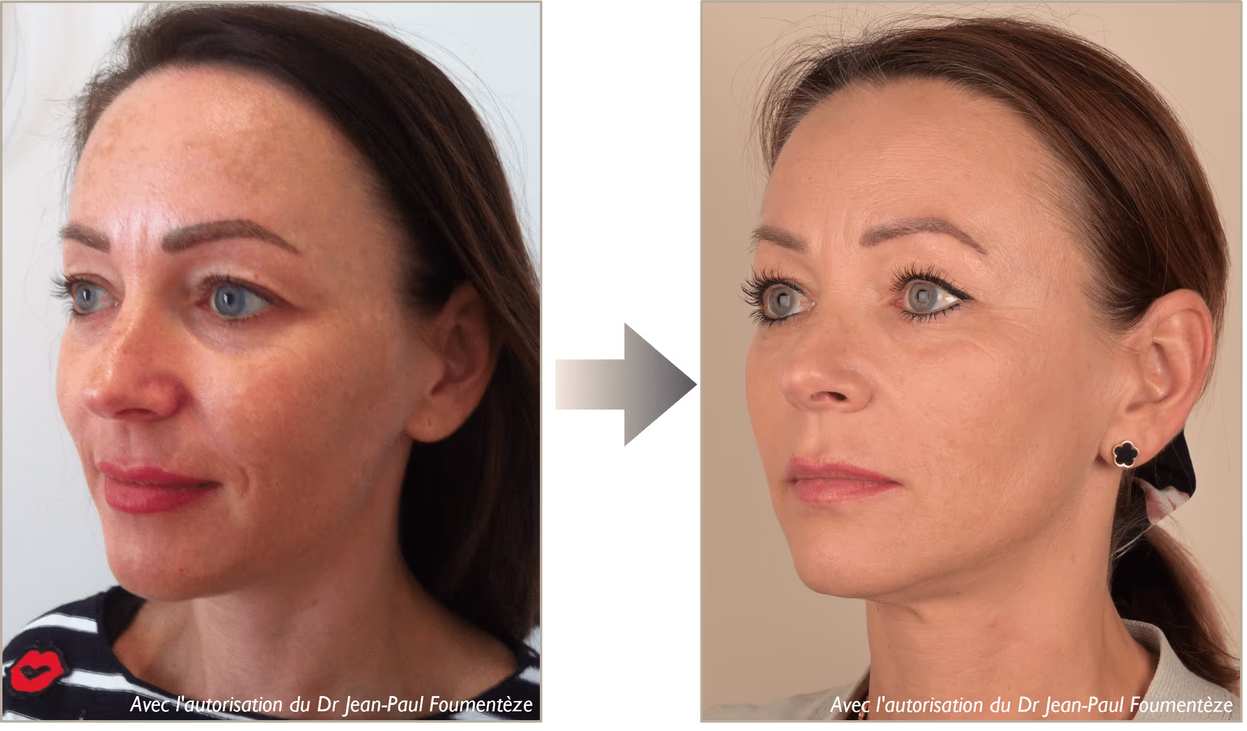 2 images d'une même femme, brune aux yeux bleus, avant et après l'opération des fils tenseurs