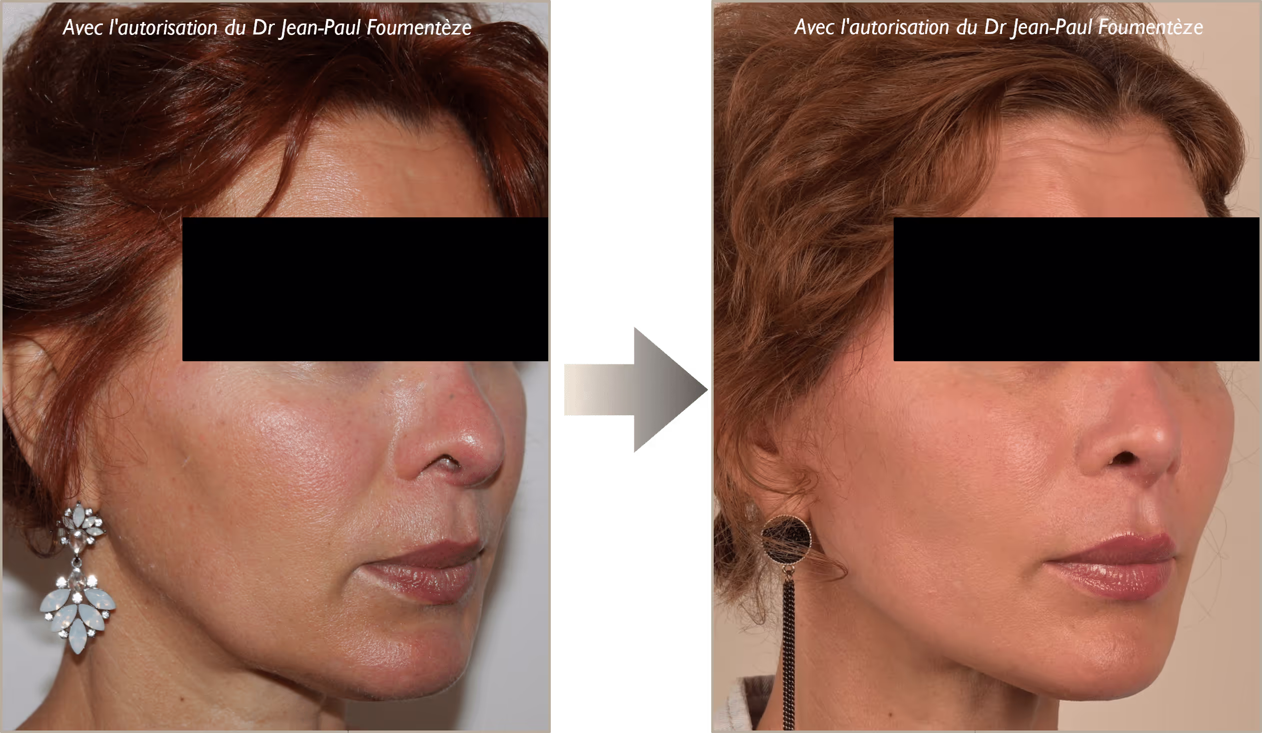 2 images d'une même femme, rousse, avant et après l'opération des fils tenseurs