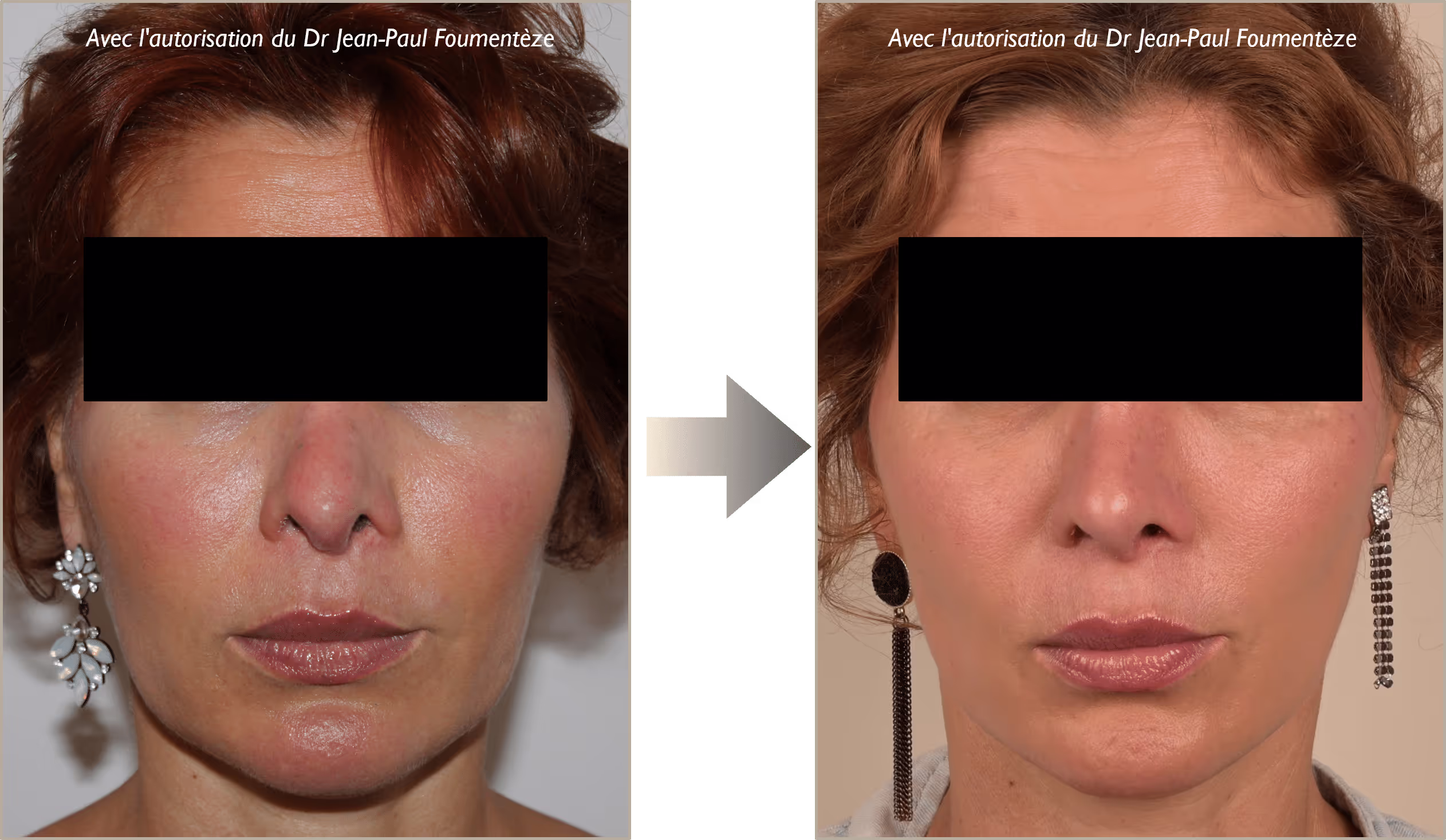 2 images d'une même femme, rousse, avant et après l'opération des fils tenseurs