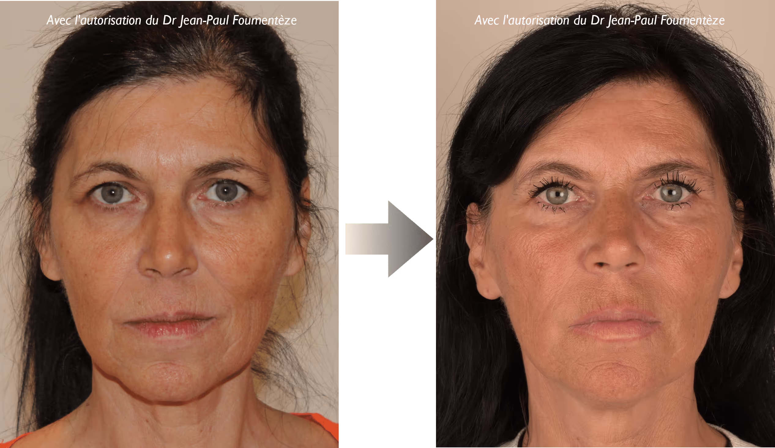 2 images d'une même femme, brune aux yeux bleus, avant et après l'opération des fils tenseurs