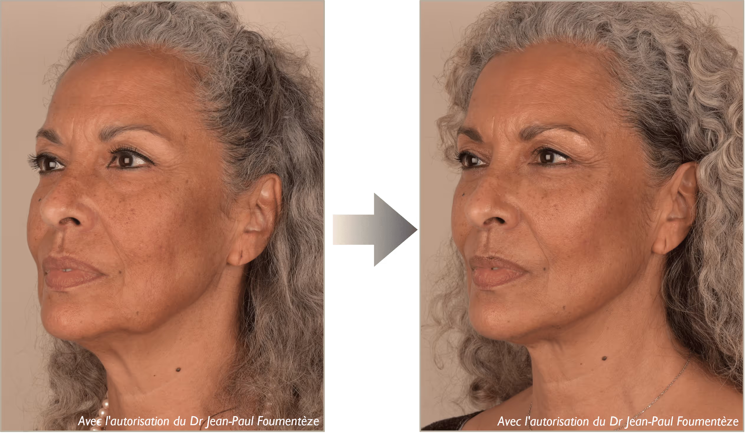 2 images d'une même femme, cheveux blancs et yeux marrons, avant et après l'opération des fils tenseurs