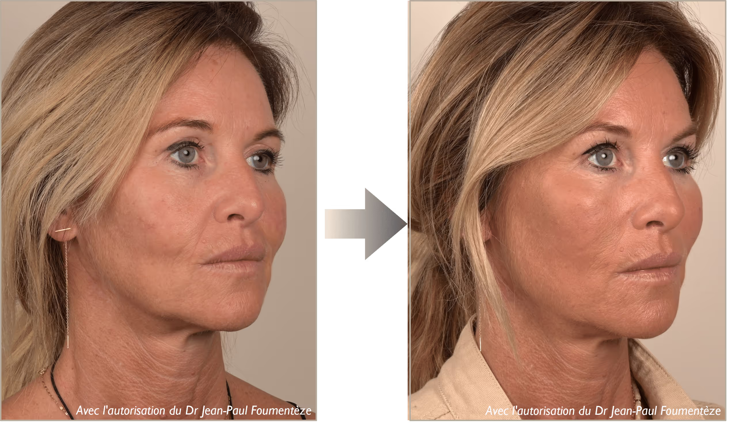 2 images d'une même femme, blonde aux yeux bleus, avant et après l'opération des fils tenseurs