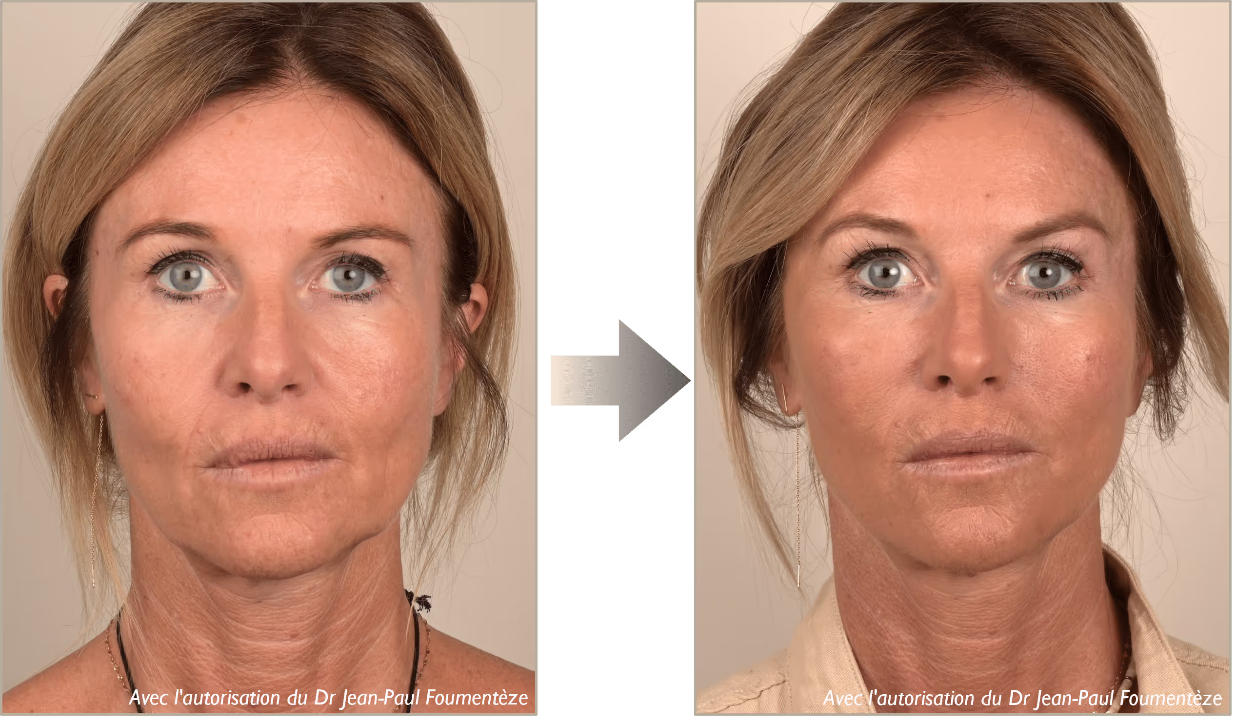 2 images d'une même femme, brune aux yeux bleus, avant et après l'opération des fils tenseurs
