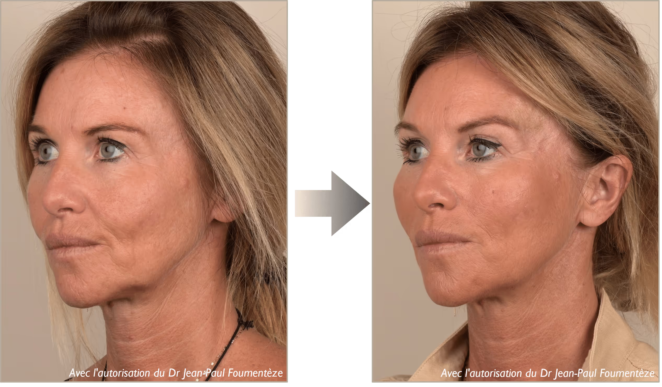 2 images d'une même femme, brune aux yeux bleus, avant et après l'opération des fils tenseurs