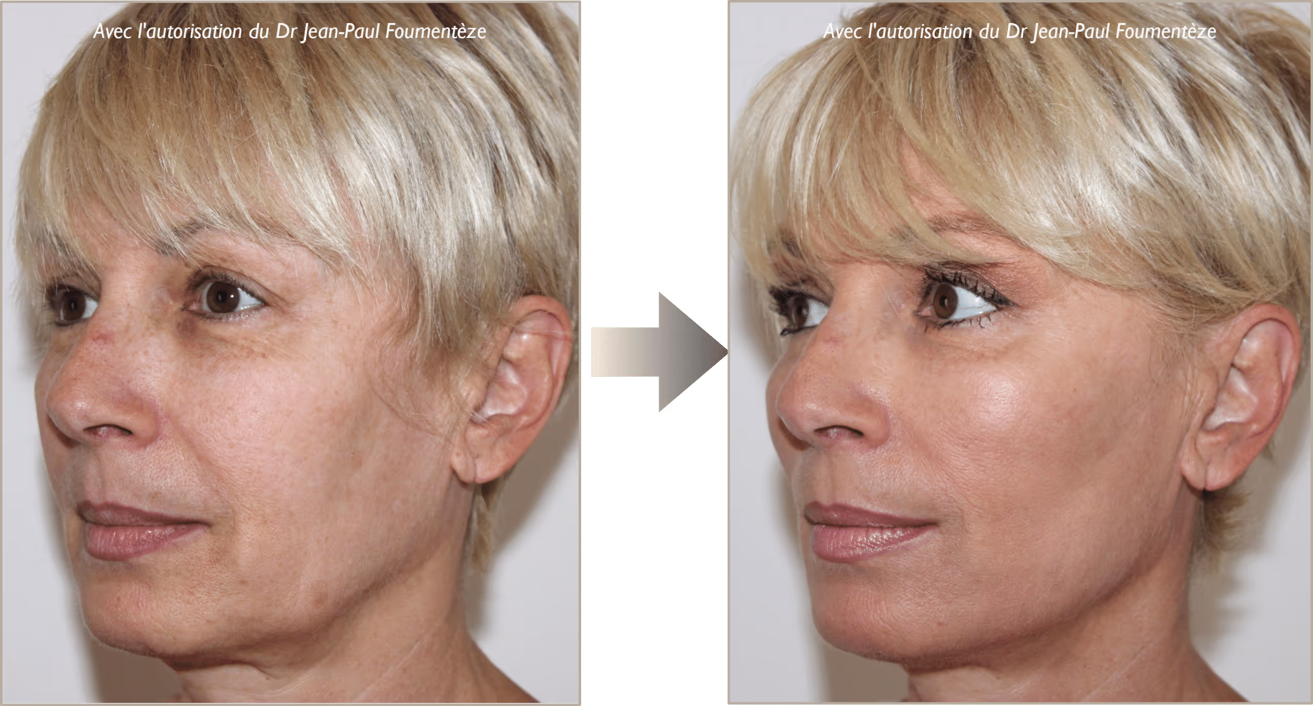 2 images d'une même femme, blonde aux yeux marrons, avant et après l'opération des fils tenseurs