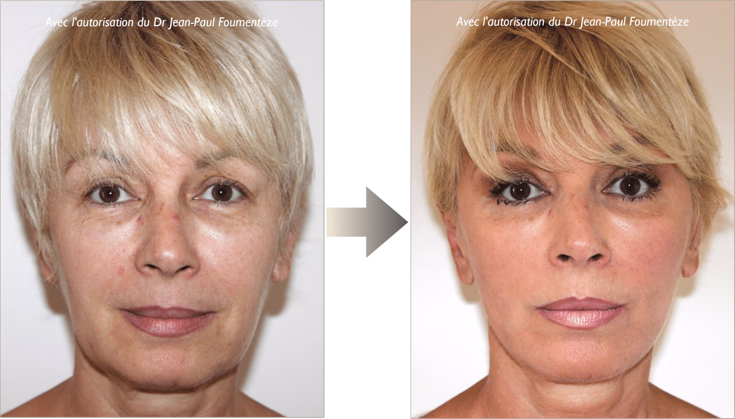2 images d'une même femme, blonde aux yeux marrons, avant et après l'opération des fils tenseurs