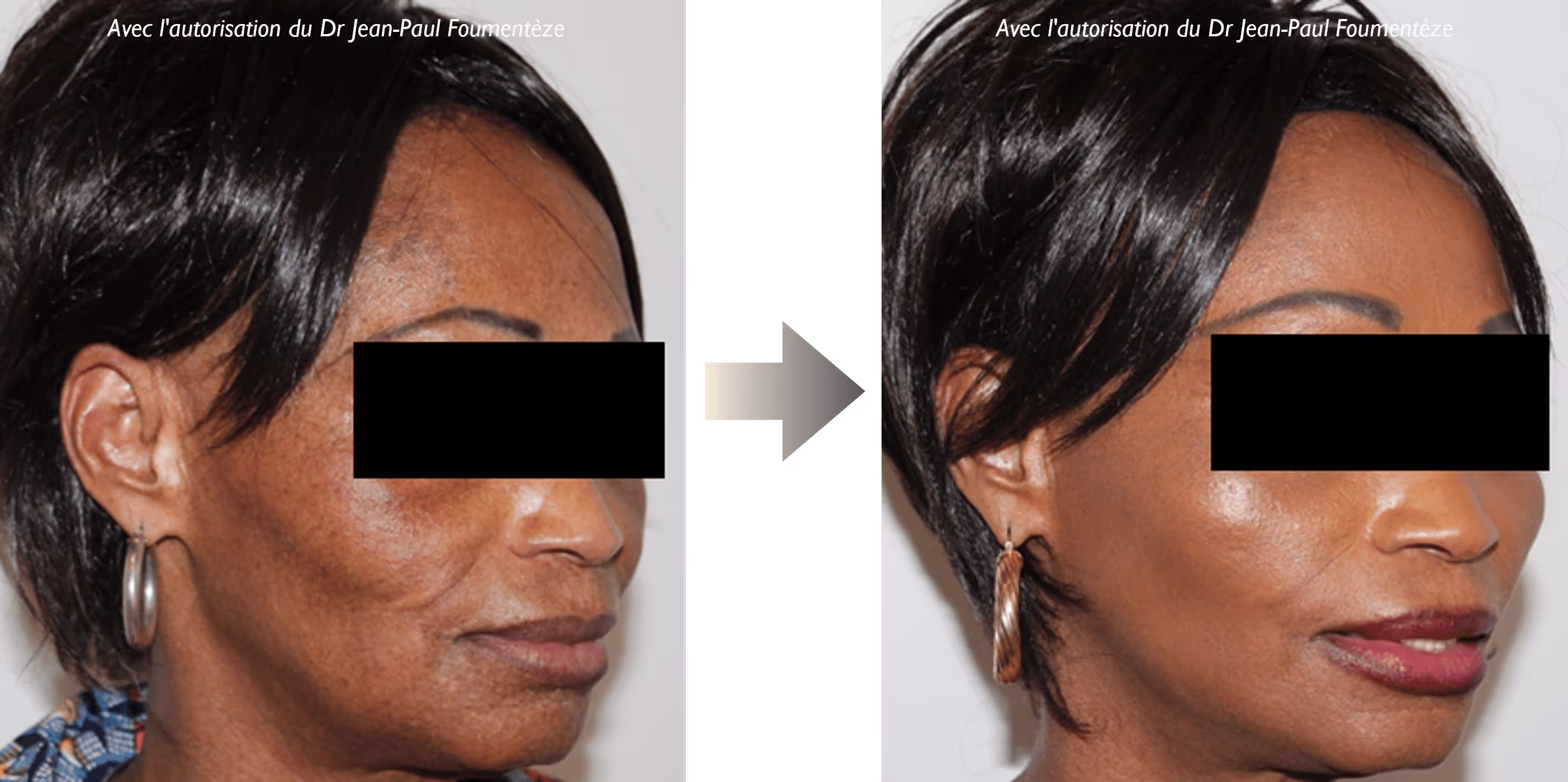 2 images d'une même femme, brune aux cheveux courts, avant et après l'opération des fils tenseurs