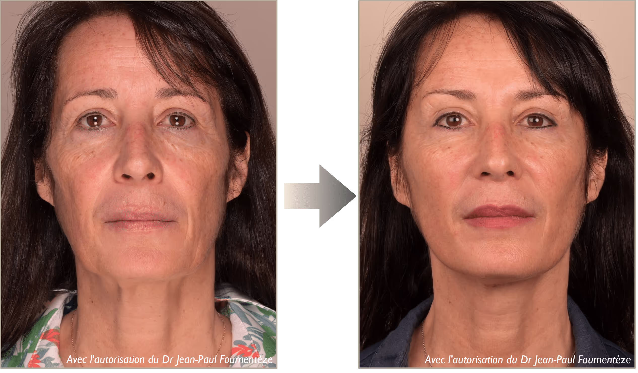 2 images d'une même femme, brune aux yeux marrons, avant et après l'opération des fils tenseurs